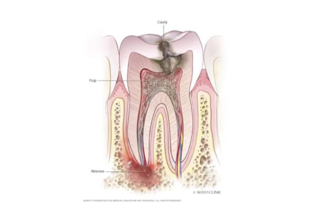 Treating an Abscessed Tooth